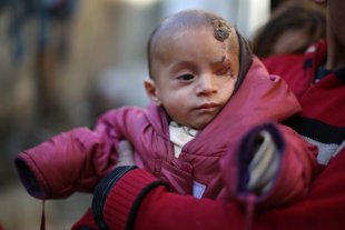 Foto de bebê que perdeu um olho em conflitos na Síria viraliza e líderes fazem demagogia